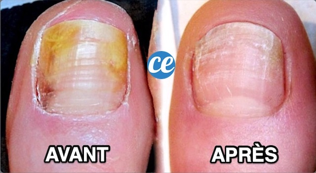 Mycoses des Ongles : Mes 5 Remèdes Naturels Pour en Venir à Bout.