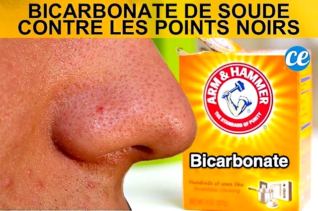 Comment Enlever les Points Noirs Avec du Bicarbonate (Facile & Rapide).