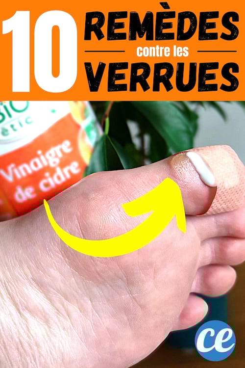 Un pied avec un pansement imbibé de vinaigre de cidre pour faire partir la verrue
