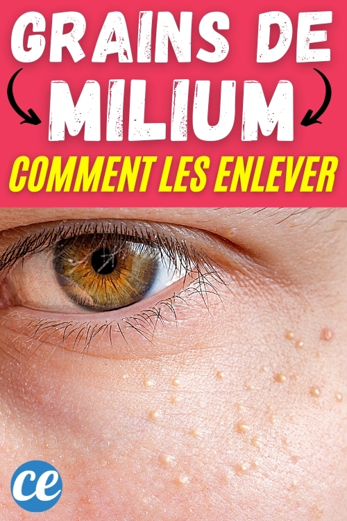 Comment Enlever les Grains de Milium Sous les Yeux ? 16 Traitements ...