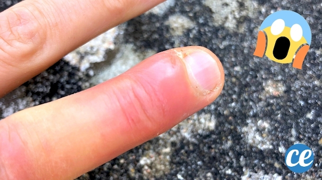 comment soigner un panaris aux pieds
