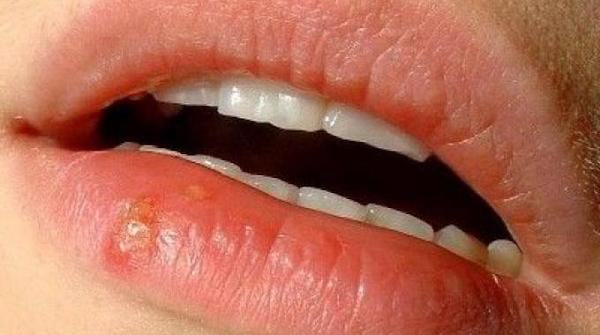 Un bouton de fièvre sur la bouche