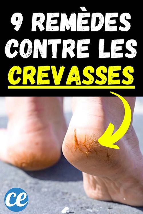 Crevasses aux Talons 9 Remèdes Naturels Pour les Soigner Vite.