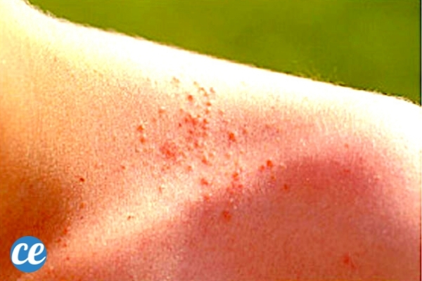 8-rem-des-qui-marchent-pour-se-d-barrasser-des-boutons-de-chaleur