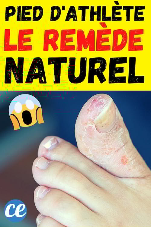 Des mycoses entre les doigts de pieds