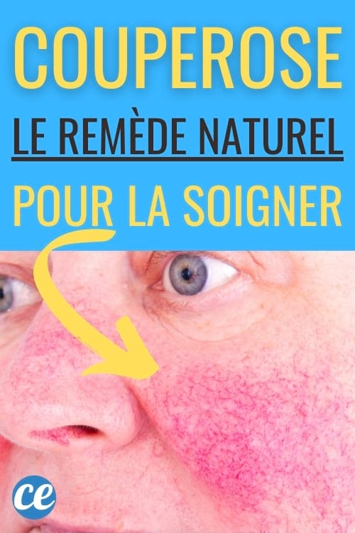 Couperose : Comment S'en Débarrasser Avec des Huiles Essentielles.