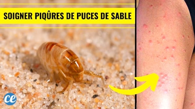 Comment soigner les piqûres de puces de sable avec du bicarbonate