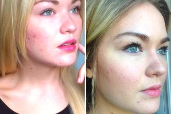 Une fille qui a de l'acné traité avec du miel pour s'en débarrasser