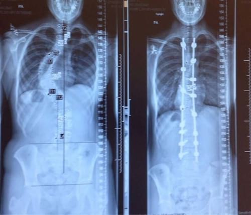 Une radiographie de la colonne vertébrale d'une personne avant et après son traitement contre la scoliose