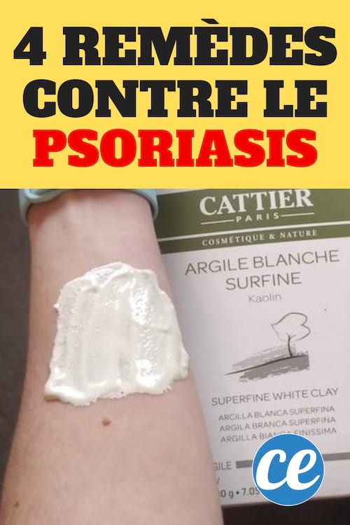 des remèdes à l'argile contre le psoriasis