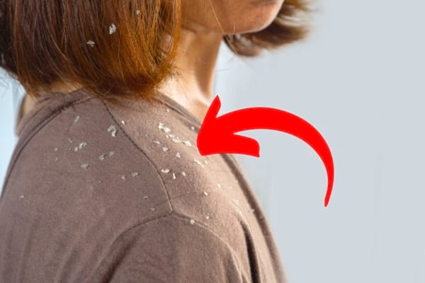 Psoriasis-Schuppen sehen aus wie große Schuppen.
