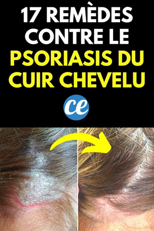 Rem Des Contre Le Psoriasis Du Cuir Chevelu R V L S Par Un Dermato