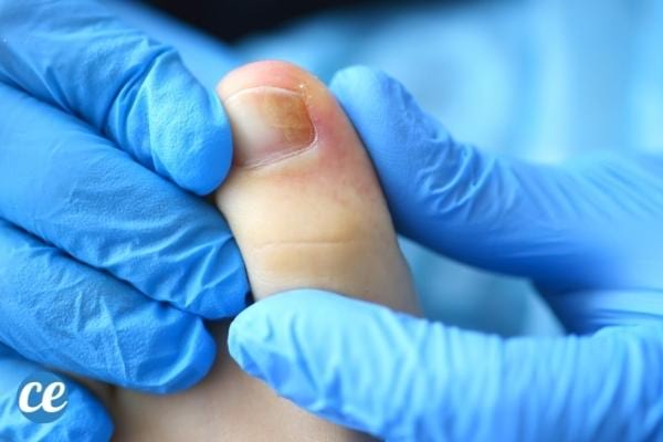 Comment soulager la douleur d'un ongle incarné ?