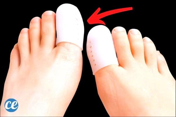 Un protège-orteil protège l’ongle incarné des pressions de vos chaussures.