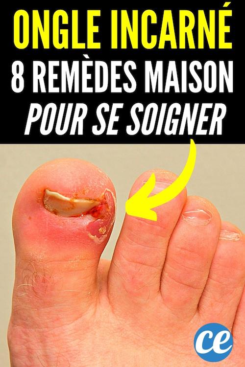 Ongle Incarné 8 Remèdes Rapides et Efficaces Pour S