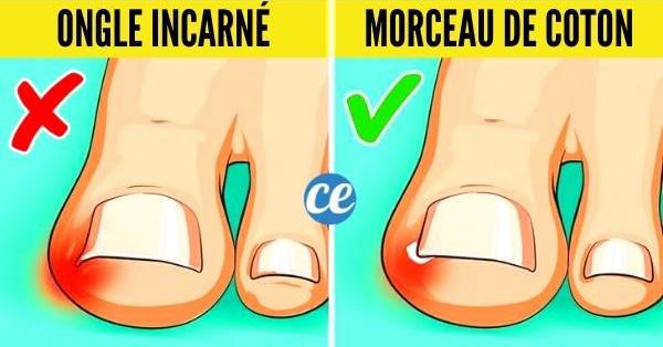 Ongle Incarné : 8 Remèdes Rapides et Efficaces Pour S'en Débarrasser.
