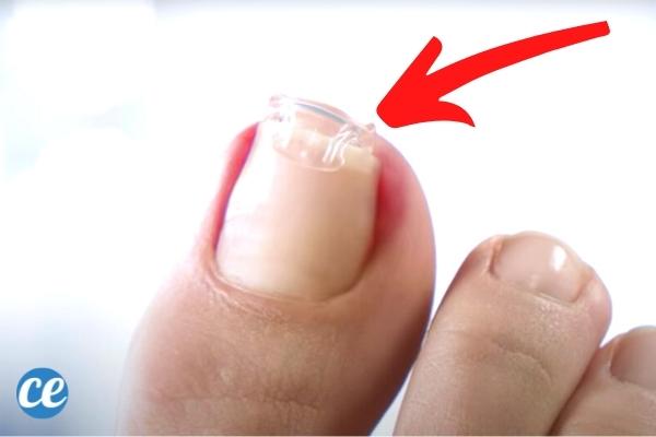 Ongle Incarné : 8 Remèdes Rapides et Efficaces Pour S'en Débarrasser.