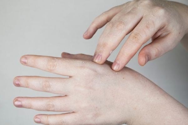 une femme se touche les mains qui pèlent à cause d'une mycose