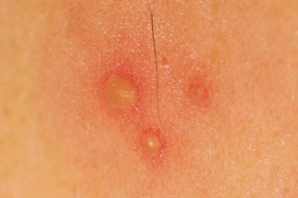 De l'herpes génital qui donne de mauvaises odeurs