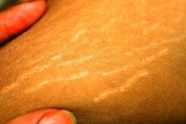 Une peau avec des vergetures qui peuvent disparaitre grâce à l'huile d'olive