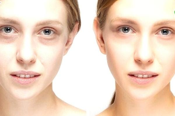 Une femme avec un teint très pâle suite à une carence en fer