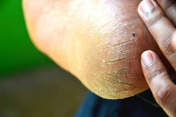 Un talon sec et rugueux que l'on peut soigner avec de l'huile d'olive