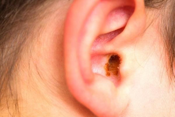 Une oreille avec du cerumen que l'on peut enlever avec de l'huile d'olive