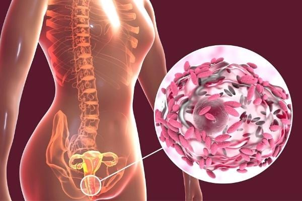 Une femme atteinte de vaginose bactérienne donnant des odeurs vaginales