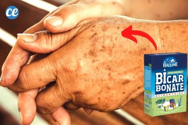 taches brunes sur les mains