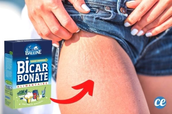 vergetures sur  les cuisses d'une femme