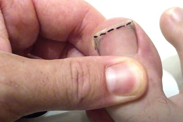 Un trait droit tracé sur l'ongle de pieds avant de le couper