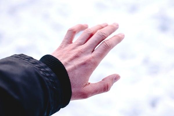 une main avec des engelures à cause du froid