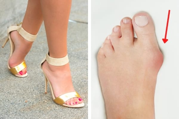 risque hallus valgus chausures à talons