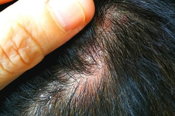 Des cheveux traités avec de l'huile d'amande douce pour éliminer les pellicules