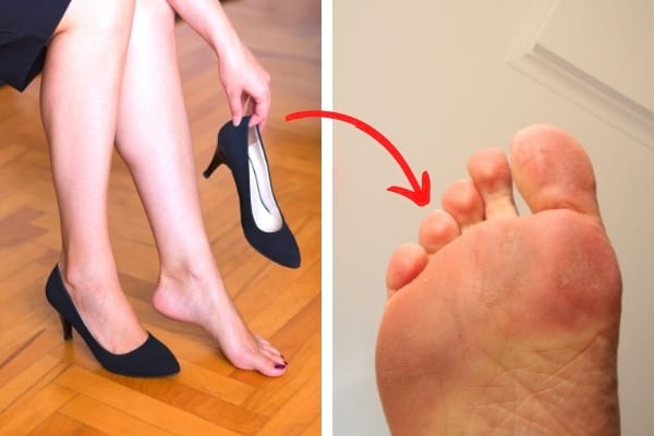 cor au pied à cause des chaussures hautes