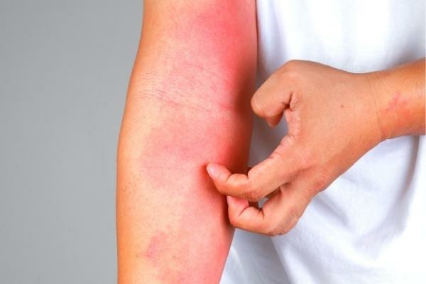 Un bras plein d'eczéma