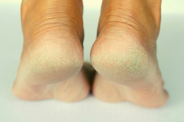 De la peau de pieds craquelée que l'on peut réparer avec l'huile d'amande douce