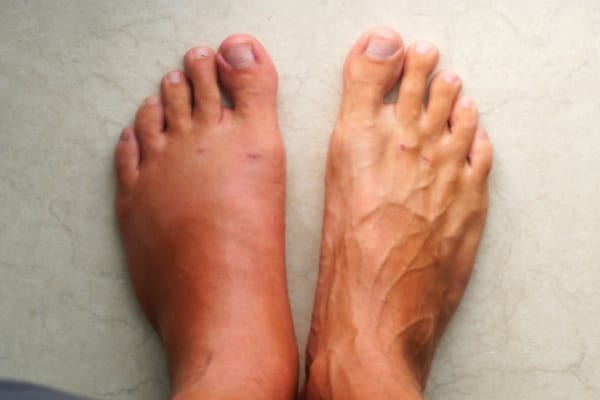 pied gonflé à cause de chaussures