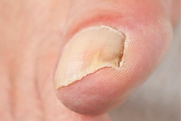 Un ongle de pieds dur qui peut être assouplit avec de l'huile d'amande douce