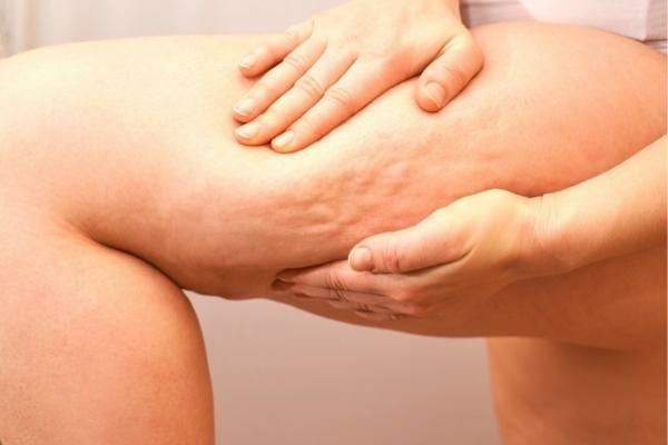 Une cuisse avec de la cellulite que l'on peut éliminer avec des massages à l'huile d'amande douce