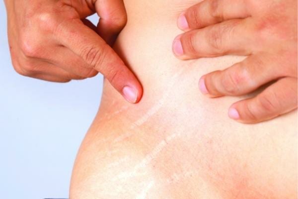 De l'huile d'amande douce permettant d'atténuer les vergetures