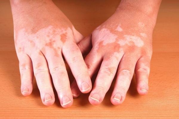 De l'huile de nigelle permettant de traiter les troubles de vitiligo