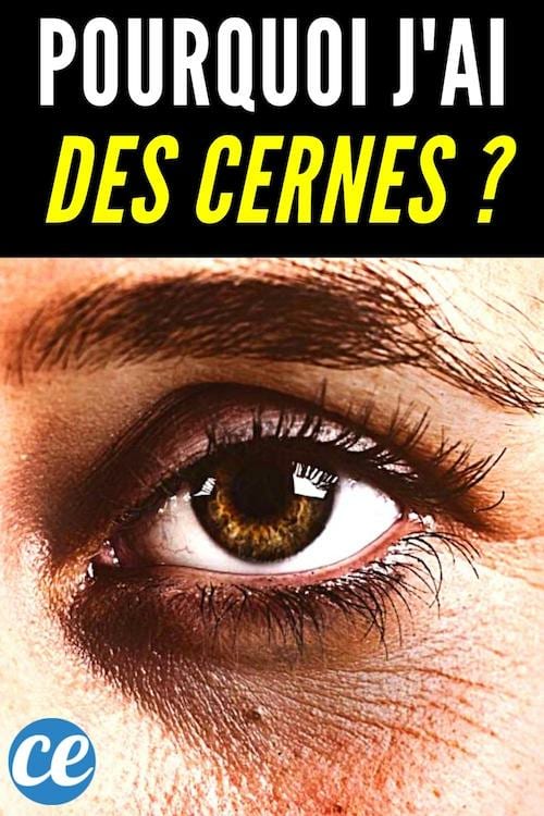 Quelles sont les causes des cernes et des poches sous les yeux ?