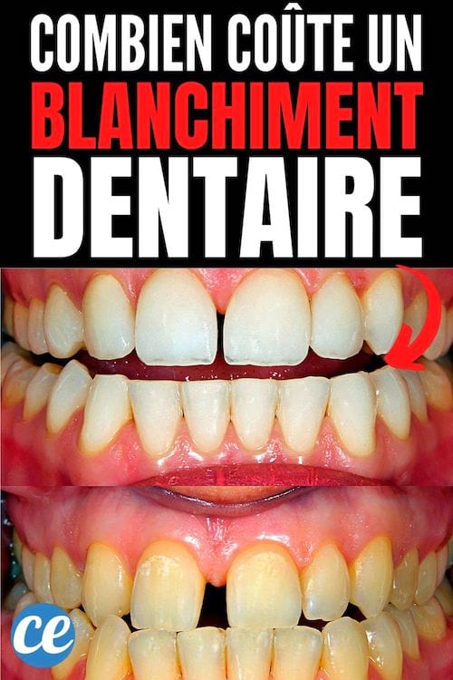 combien coute un blanchiment dentaire