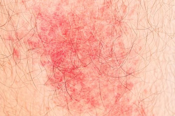 Une éruption cutanée créée à cause de pucerons