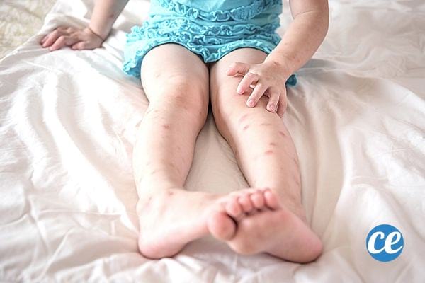 une petite fille avec plein de piqûres de moustiques sur les jambes