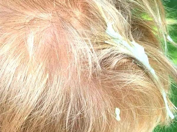 Du chewing gum dans les cheveux avec de la mayo pour l'enlever