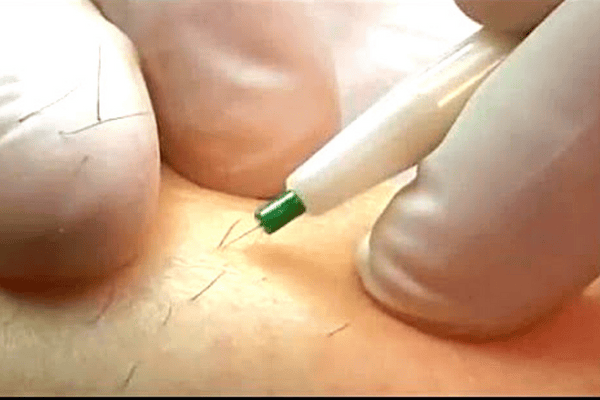 une épilation à l'électrolyse sur un menton de femme à poils