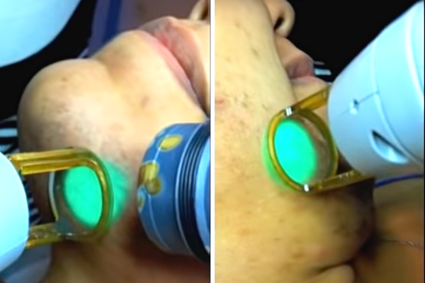 Une femme qui s'épile au laser pour faire disparaitre les poils au menton