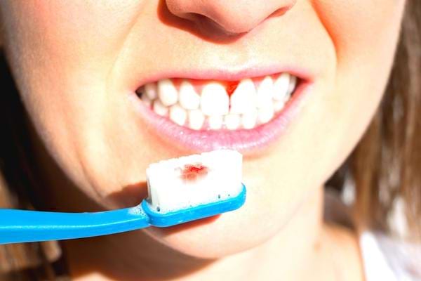 Une femme qui saigne des gencives à cause d'un brossage trop fort